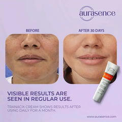 TRANACIX  Skin Tone Imperfections Care Cream with 3% Tranexamic acid | Reduces Melasma | Fades dark spots  – 30g