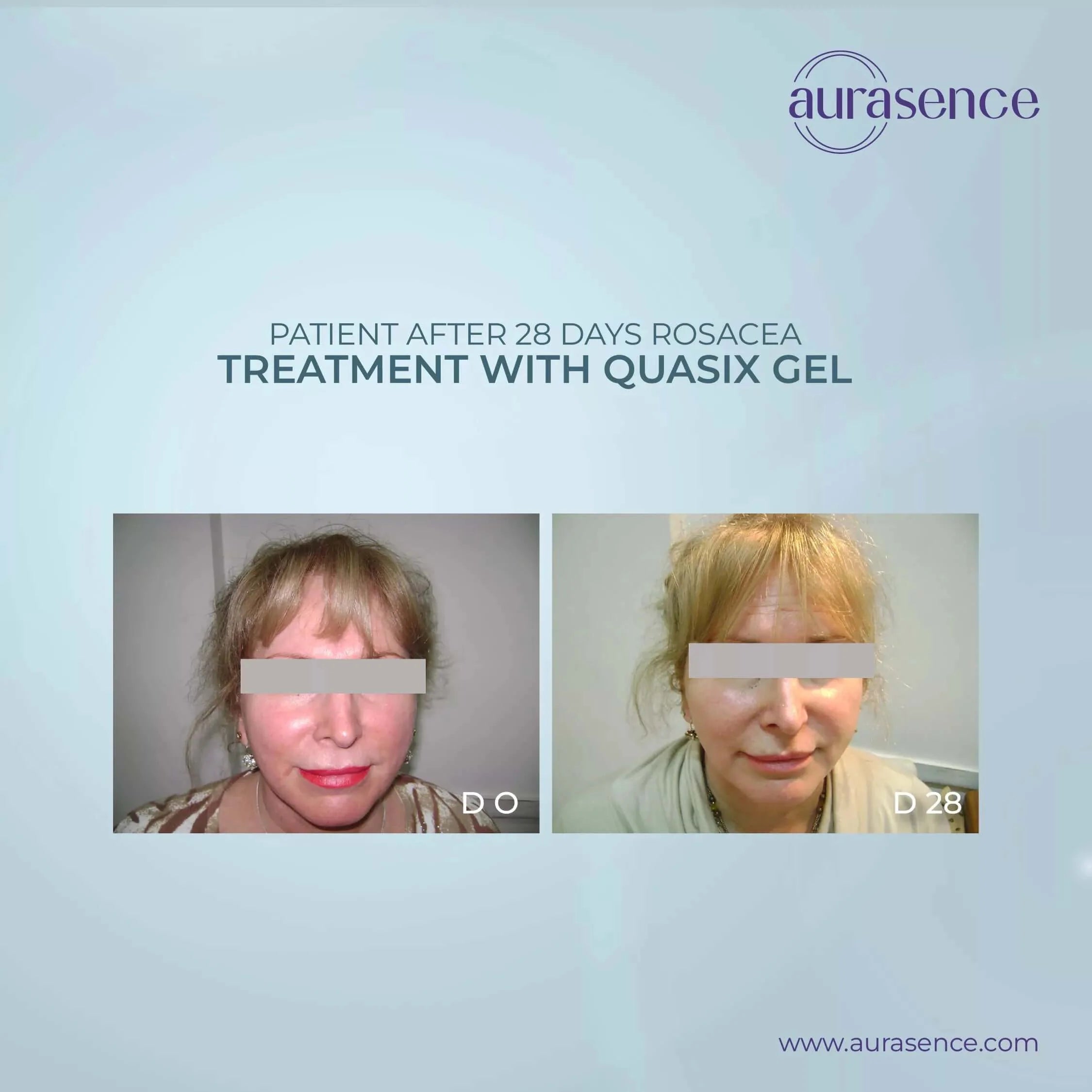 QUASIX Anti Redness Gel | Anti-Redness & Moisturizer for Oily Skin | Soothes Irritation & Hydrates Oily Skin | Quassia Amara extract – 30ml