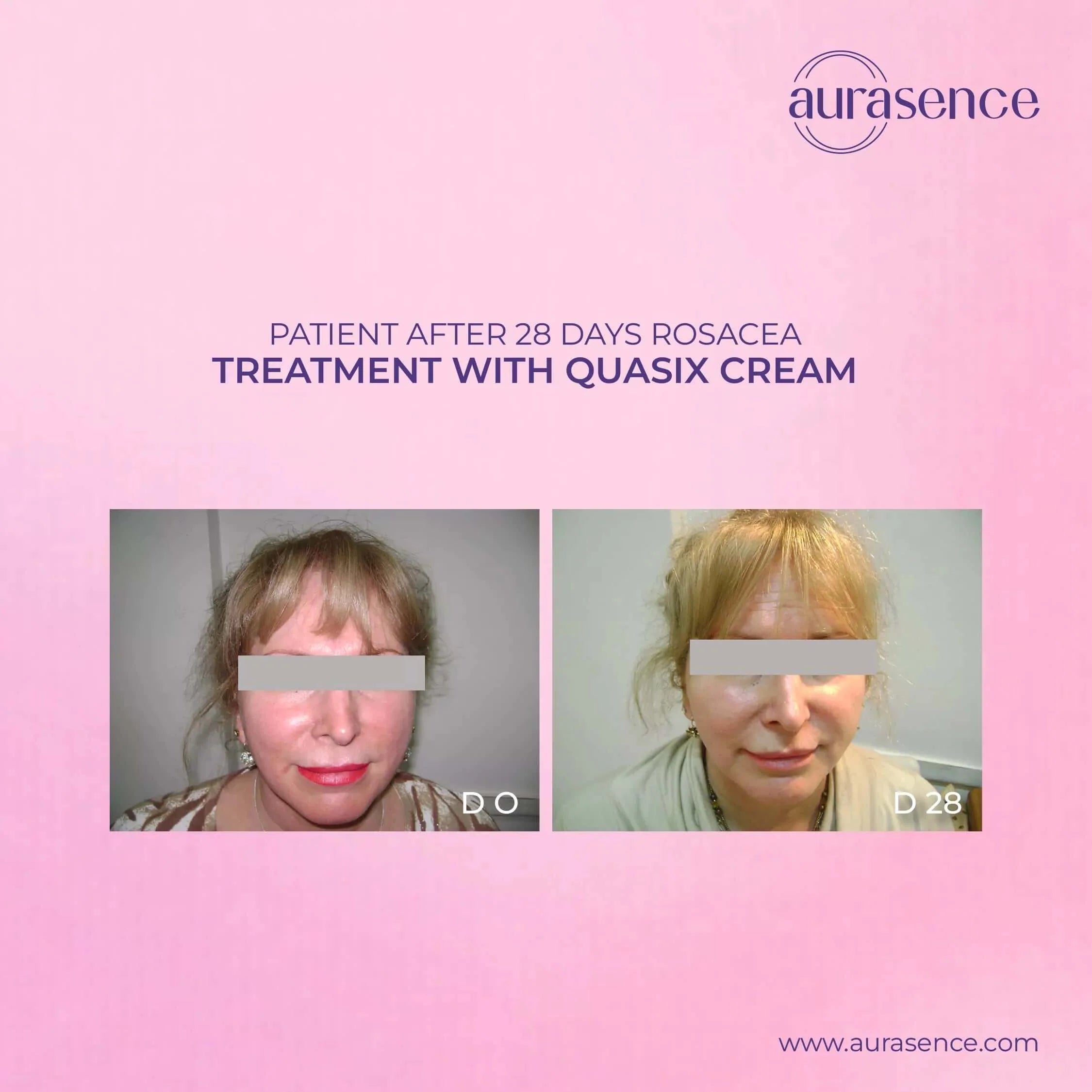 QUASIX Anti Redness Cream | Anti-Redness & Moisturizer for Dry & mixed | Soothes Irritation & Hydrates  | Quassia Amara extract – 30ml