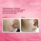 SODERMIX Soothing Repairing Cream | steroid-free solution for hypertrophic and keloid scars- 15ml