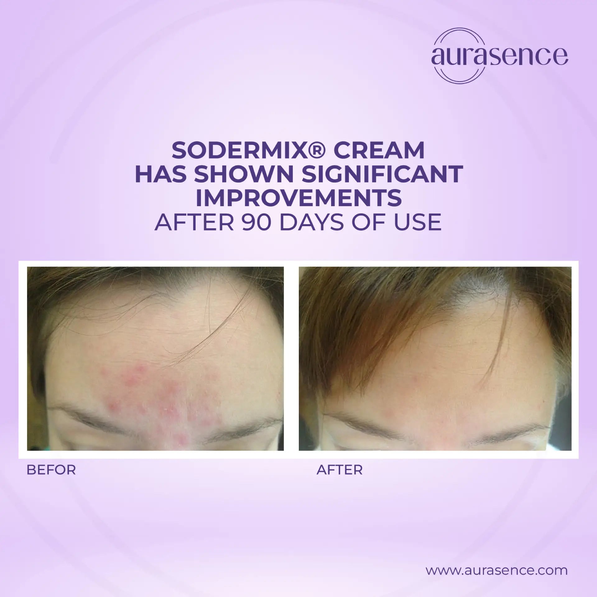 SODERMIX Soothing Repairing Cream | steroid-free solution for hypertrophic and keloid scars- 30ml