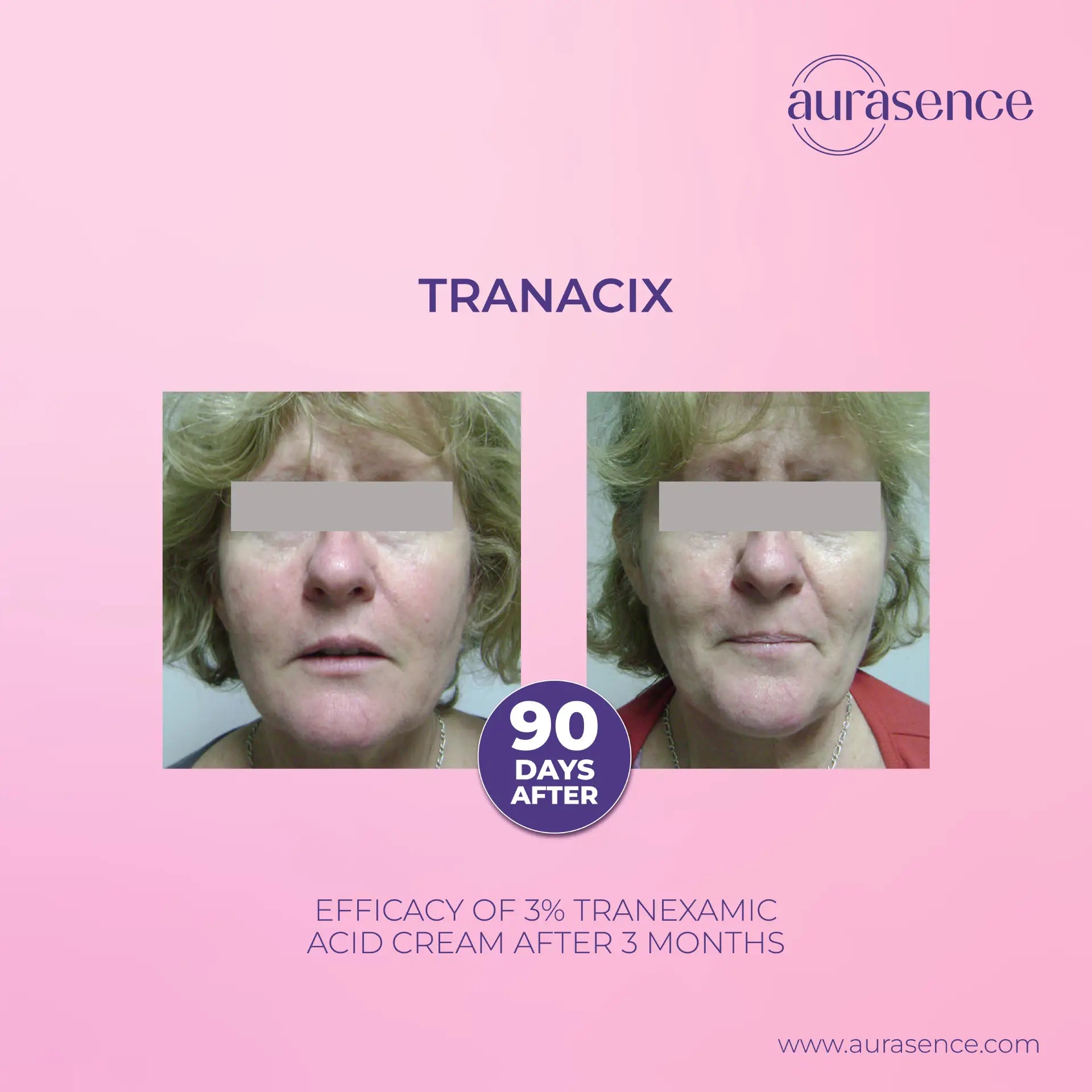 TRANACIX  Skin Tone Imperfections Care Cream with 3% Tranexamic acid | Reduces Melasma | Fades dark spots  – 30g